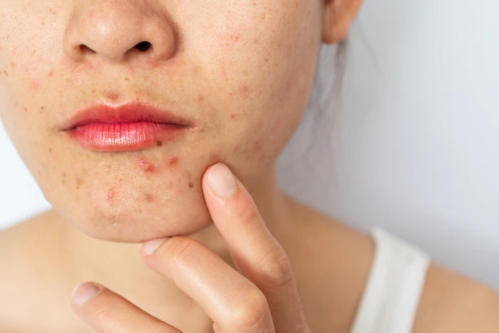 Acne: O que é, Causas, Sintomas, Tratamento e mais