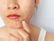 Acne: O que é, Causas, Sintomas, Tratamento e mais