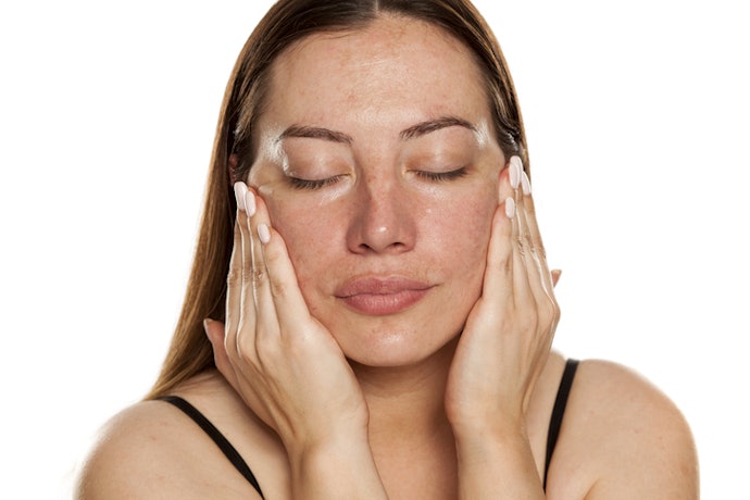 O que Fazer para Potencializar o Tratamento com o Creme para Melasma?