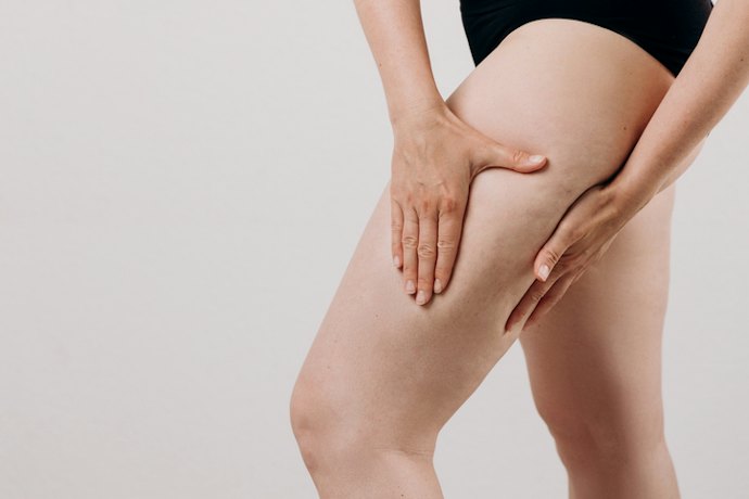 O que É o Lipedema?