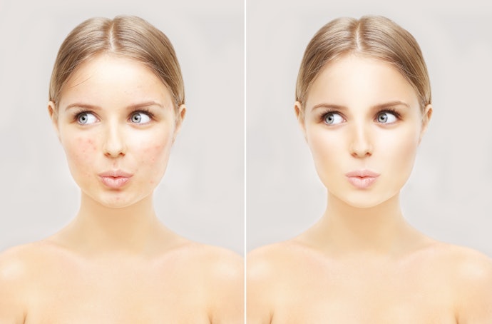 Como o Peeling Funciona? Ele Sempre Causa Descamação?