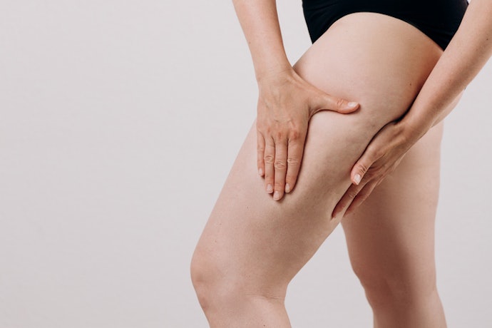 O que É o Lipedema?