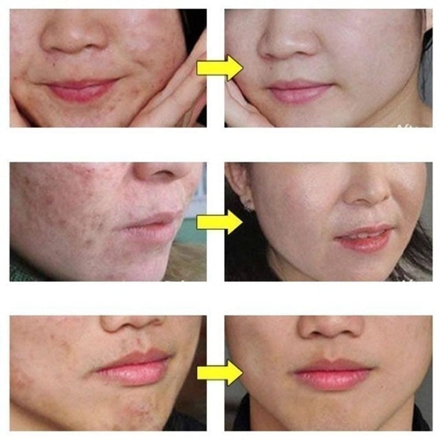 Creme Removedor de Acne e Cicatriz Pure Skin Translation missing: pt-BR.activerecord.decorators.item_part_image/alt