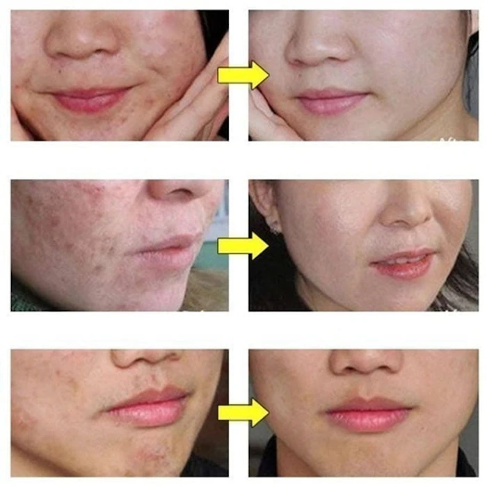 Creme Removedor de Acne e Cicatriz Pure Skin Translation missing: pt-BR.activerecord.decorators.item_part_image/alt
