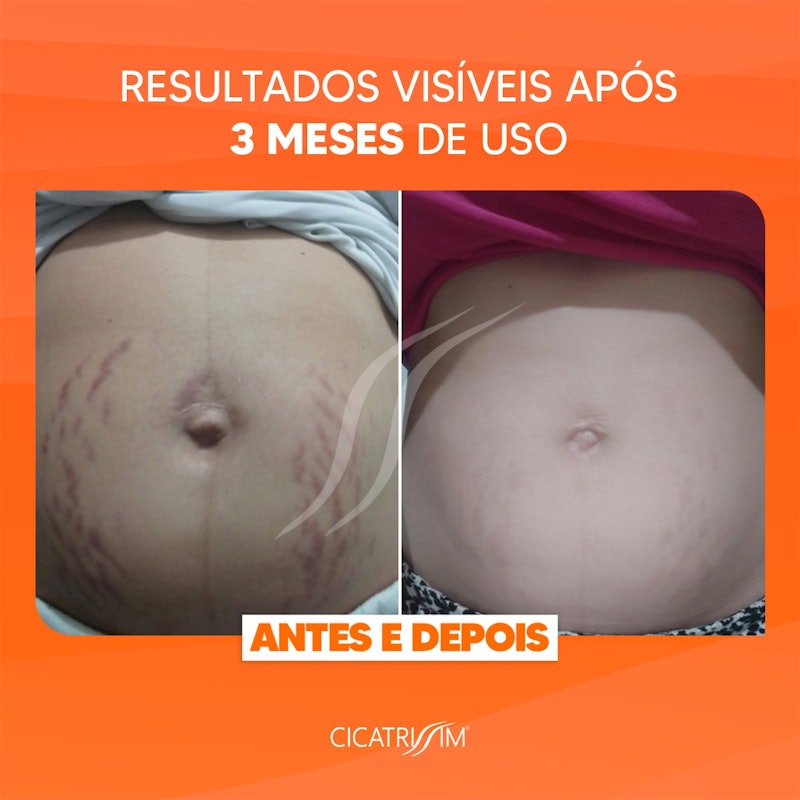 Creme para Estrias 3