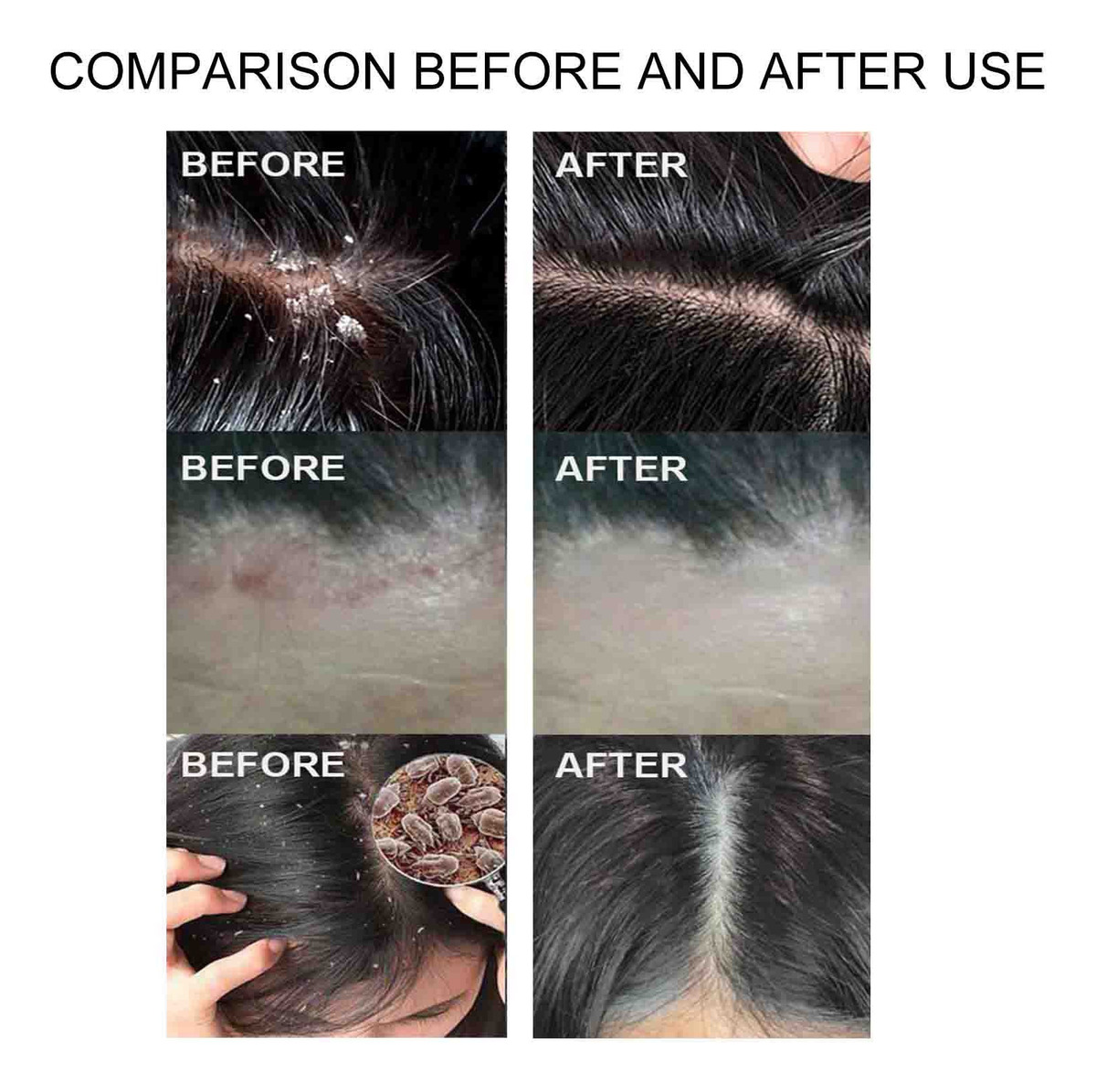 Shampoo de Enxofre para Piolhos 4