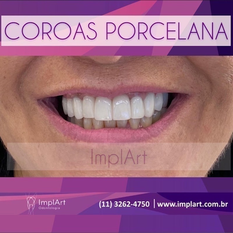 ImplArt Odontologia 3