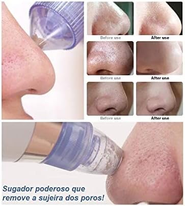 Aparelho Removedor Sucção de Cravos DermaSuction 2
