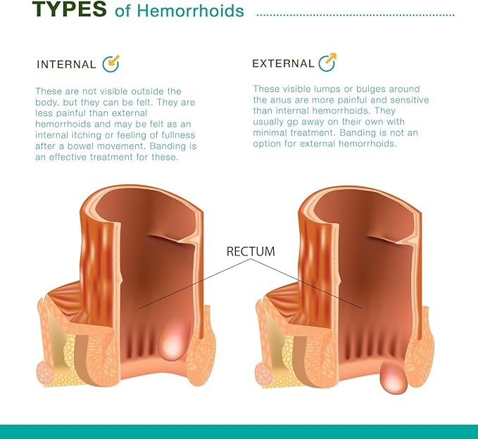 Reejoys Hemorrhoid Cream: Advanced Herbal Hemorrhoids 3