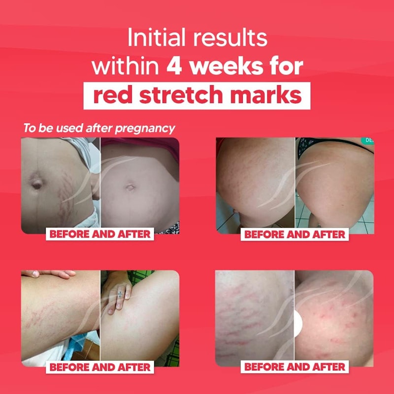 CicatriSSim Red - Específico para Estrias Vermelhas 4