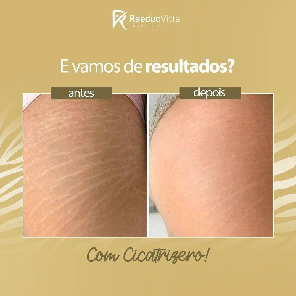 Cicatrizero Creme para Estrias 3