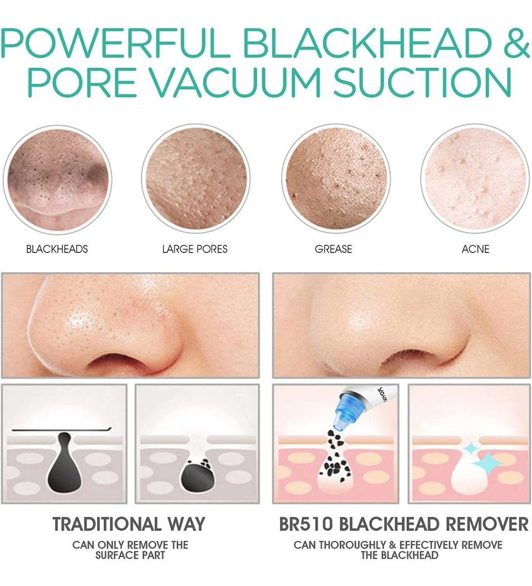 VOYOR Blackhead Vacuum Removal Tool 3