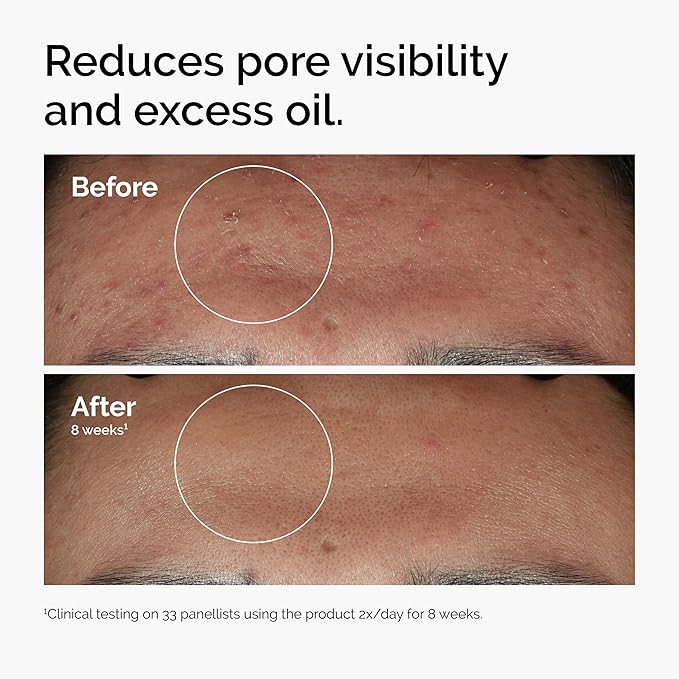 Niacinamide 10% + Zinc 1% - Clareador de Pele e Controle de Oleosidade 5