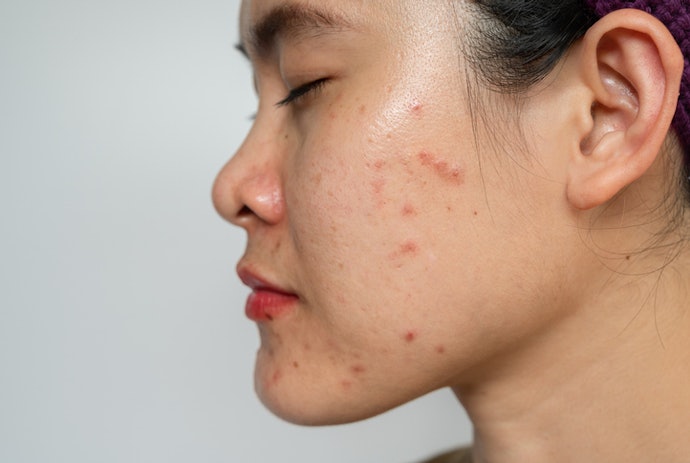 Se Também Tem Problemas com Acne, Prefira Hidratante com Niacinamida e Outros Ativos