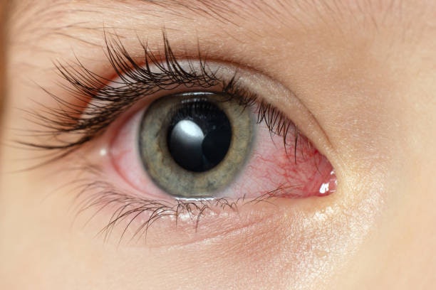 Para Peles e Olhos Sensíveis, Evite Removedor com Solventes Agressivos e Fragrância Intensa