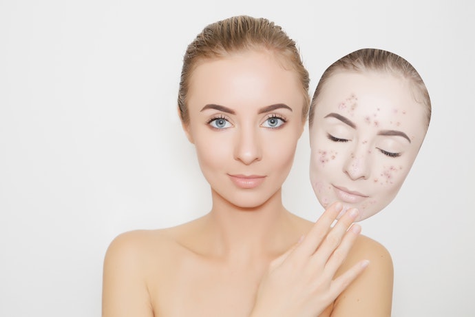 Para Tratar Acne, Prefira Produtos Próprios para Pele Acneica ou Oleosa