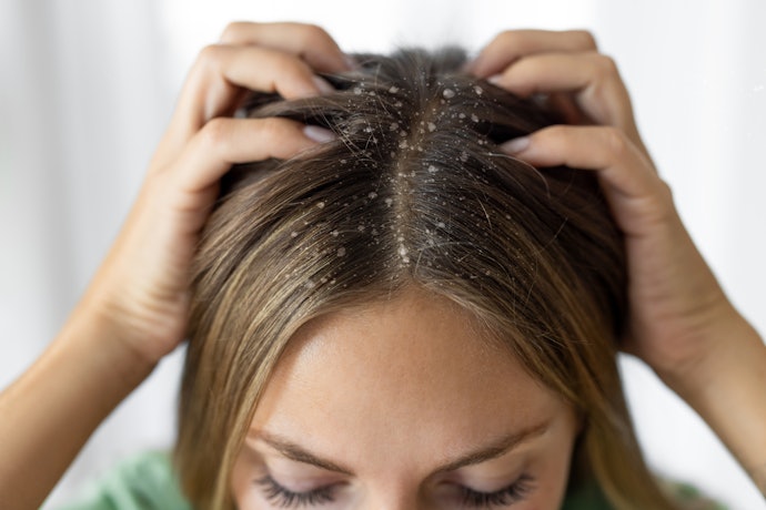 Tem Caspa e Dermatite Seborreica? Escolha um Shampoo Anticaspa com Antifúngicos e Reguladores