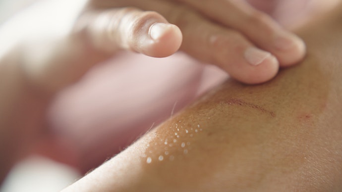Para Cicatriz Leve ou Pele Oleosa, Opte pela Pomada em Gel