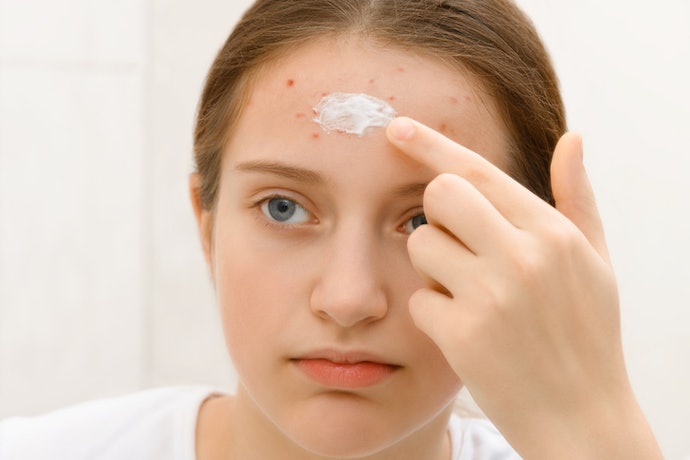 Para Tratar Acne e Manchas, Opte por Pomadas com Ativos Clareadores como a Niacinamida