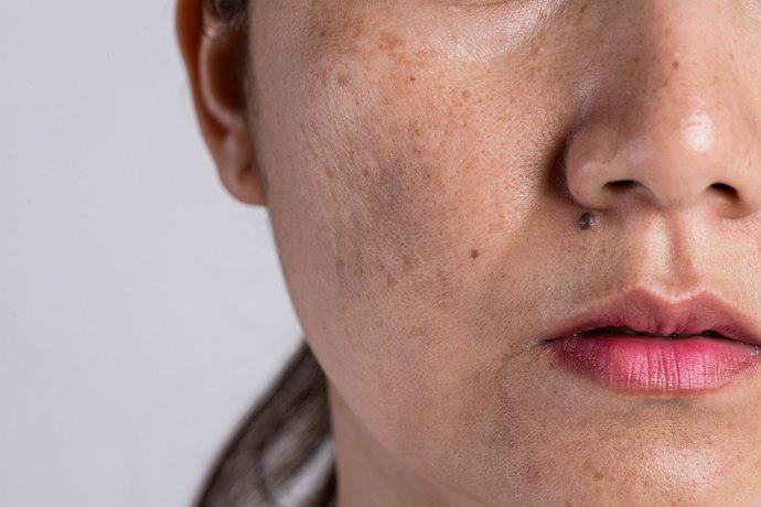 Peles Mistas ou Oleosas: Prefira as Formulações Oil Free