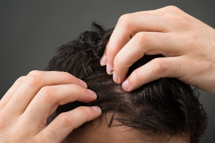 Para Tratar a Caspa Excessiva e Persistente, Escolha Shampoos com Cetoconazol na Fórmula