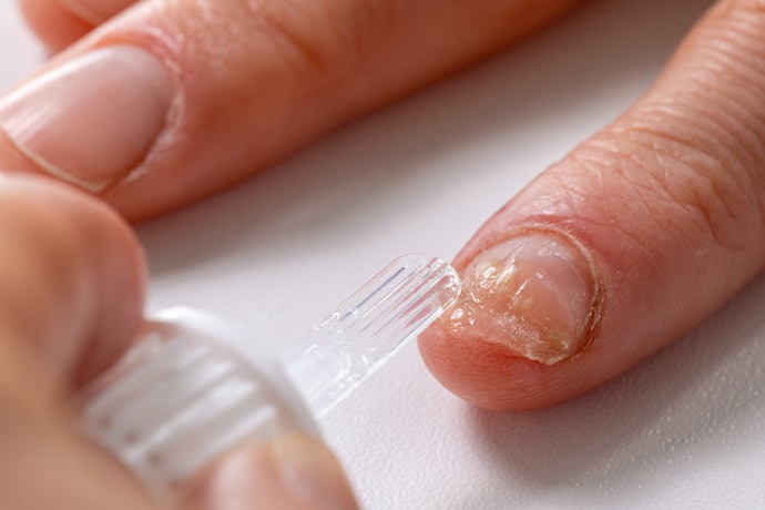 Para Tratar Fungos, Prefira Esmaltes com Amorolfina, Terbinafina, Ciclopirox e Fluconazol