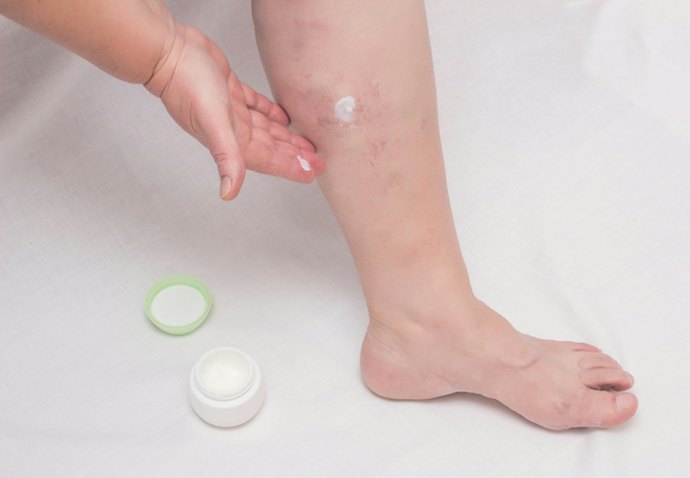 Se Busca um Creme Anti-Inflamatório para Lipedema, Invista em Opções com Camomila e Niacinamida