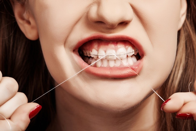 Se Usa Aparelho Fixo, Prefira o Fio Dental Ortodôntico para Passar entre Dentes Facilmente