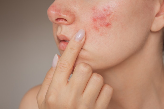 Sua Acne Está Inflamada? Prefira Pomadas com Ativos Anti-inflamatórios e Bactericidas