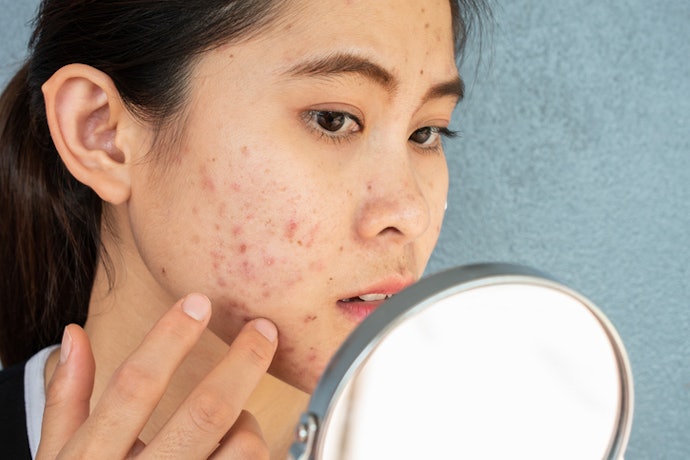 Se Tem Lesões Causadas por Acne, Escolha Cicatrizante com Ação Anti-inflamatória